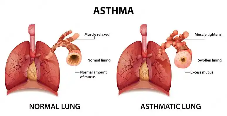 Asthma Can air purifiers help with asthma